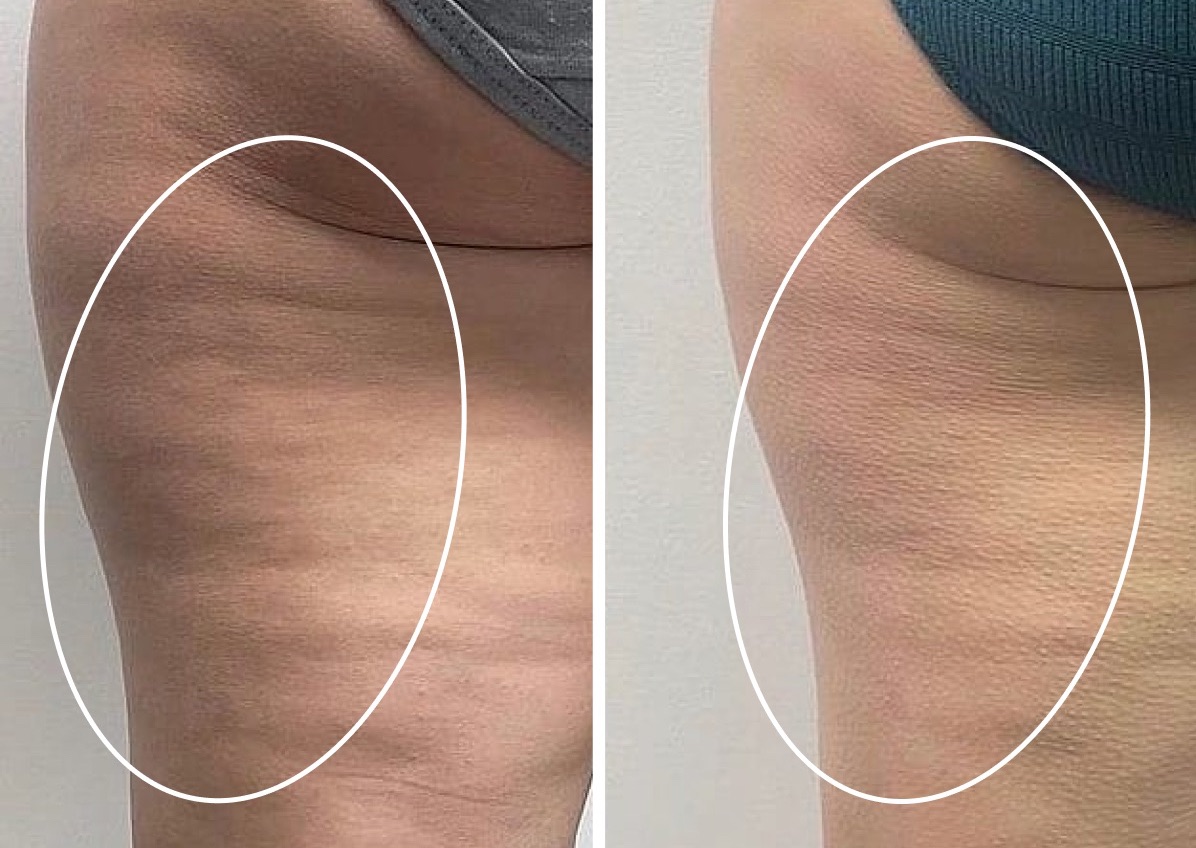 Bionexis 3 Cellulite Treatment Front side