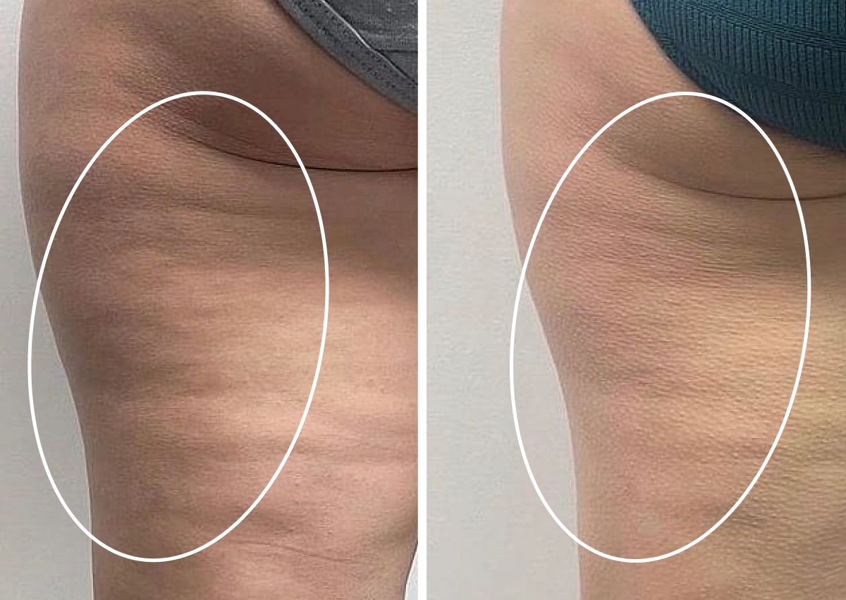 Bionexis 3 Cellulite Treatments front back side