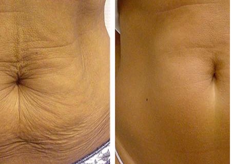 Stertch marks & scar removal treatment