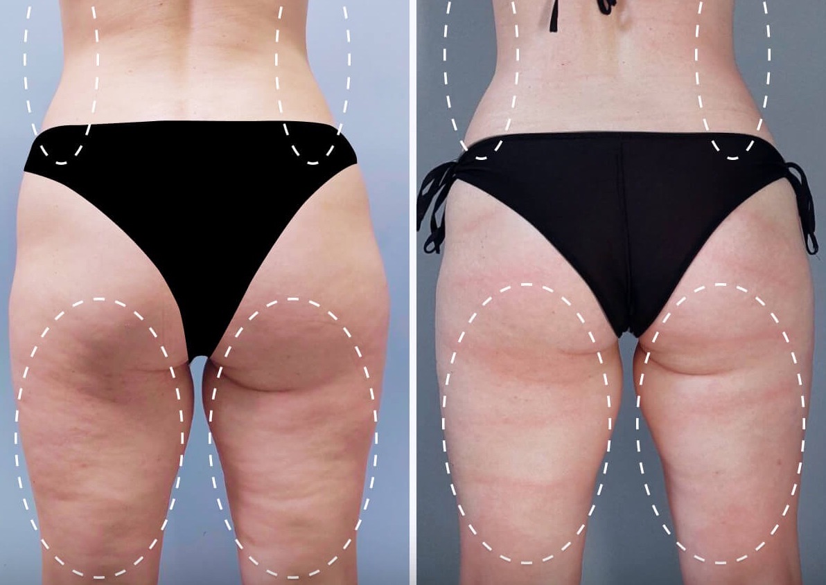 Bionexis Brazillian Bum Lift 3 Sessions