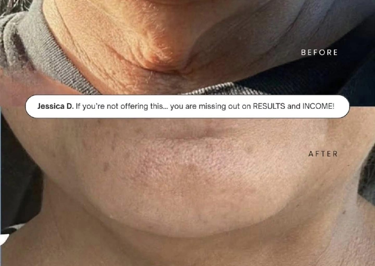 Chin Reduction 3 sessions 