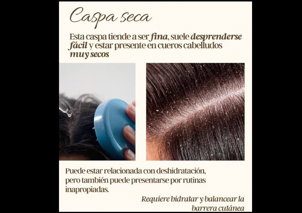 Tratamiento para la caspa | Dandruff Treatment