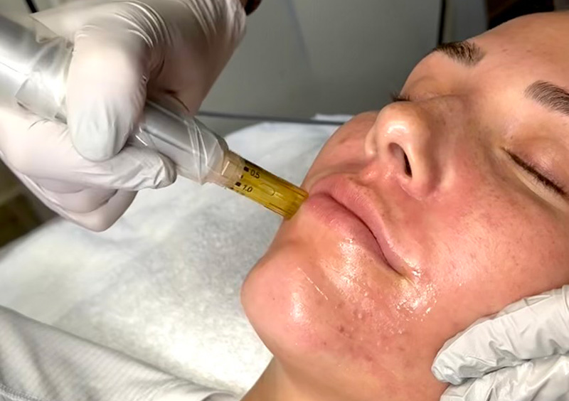 Microneedling 