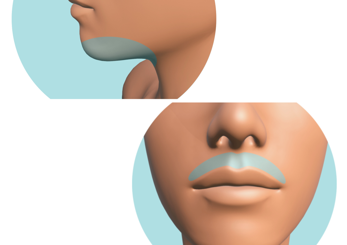 Depilación láser diodo Bigote (3 Sesiones)