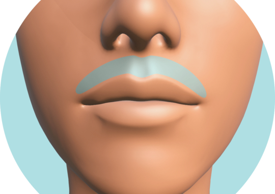 Depilación láser diodo Bigote ó Barbilla (6 Sesiones)