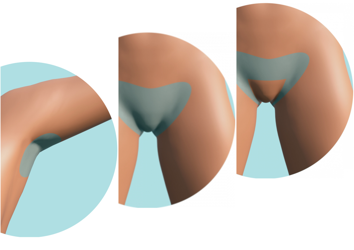 Combo Depilación láser diodo Axilas + Brazilian o Bikini Line