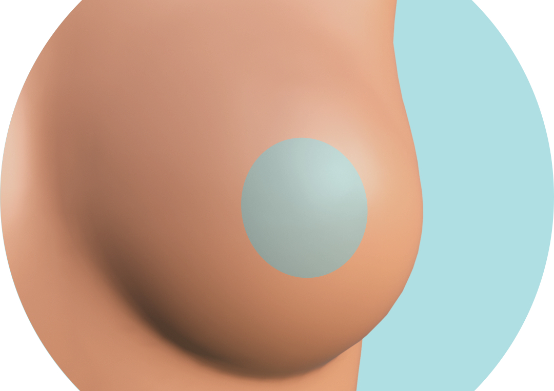 Depilación Láser Diodo - Areolas