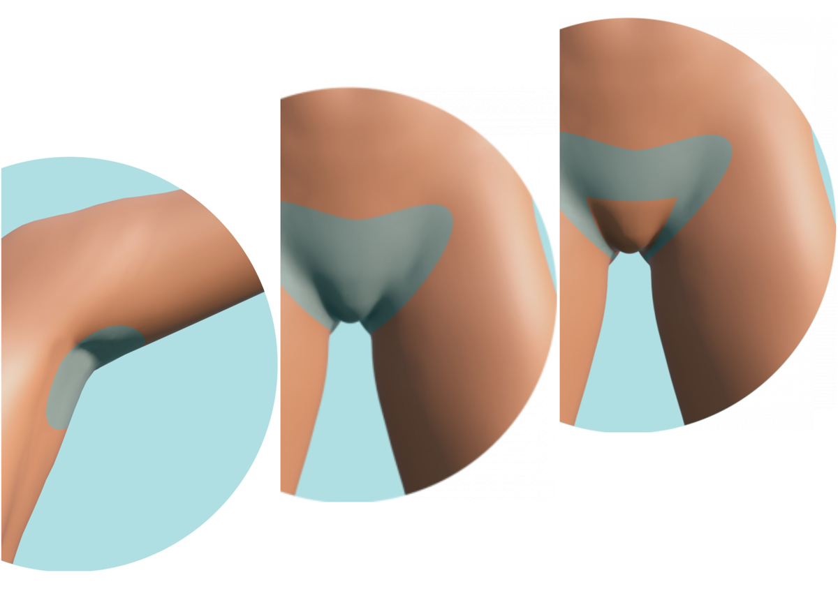 Depilación láser diodo Axilas + Brazilian ó Bikini Line 3 (Sesiones)