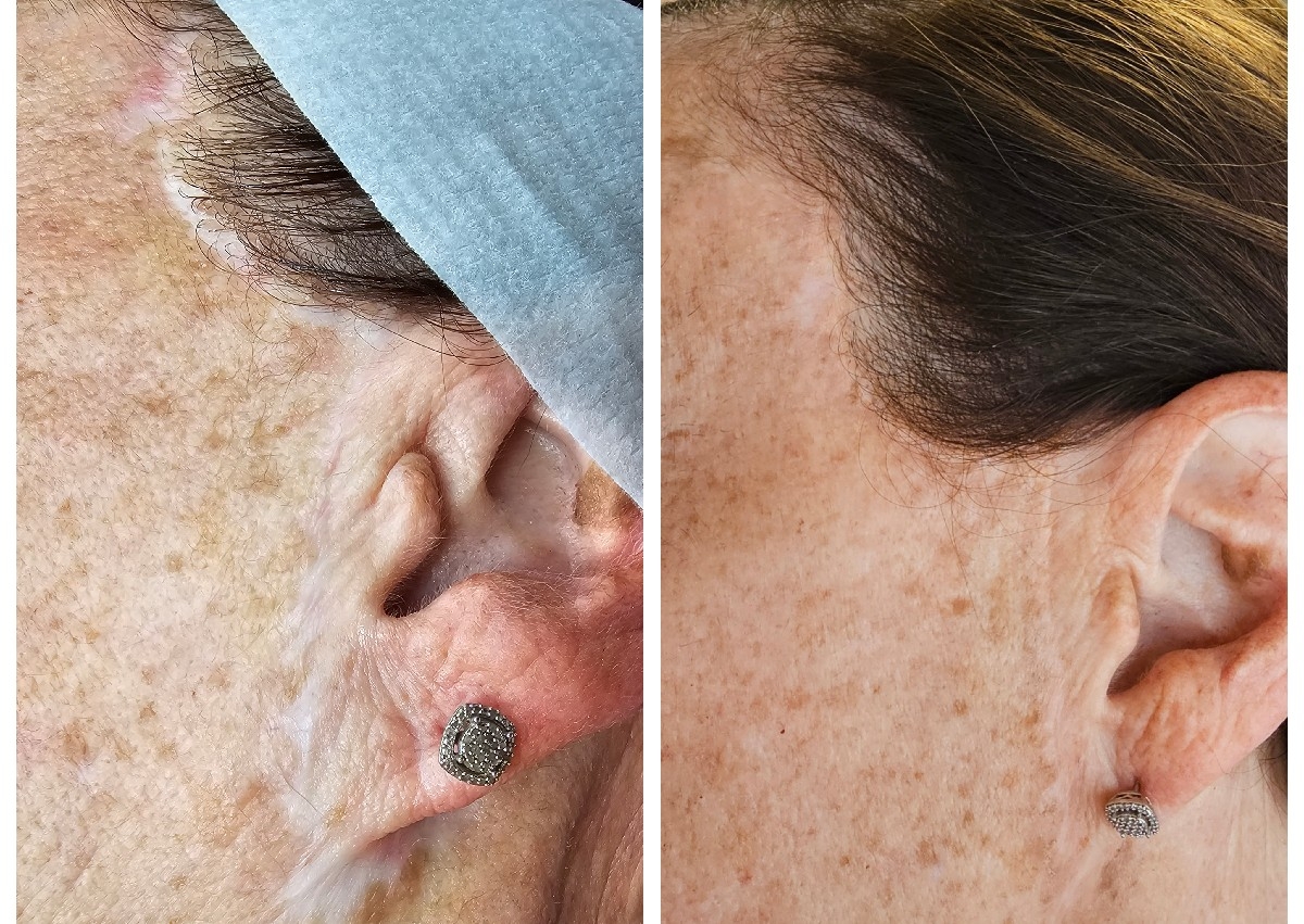 Scar, Stretch Marks Camouflage