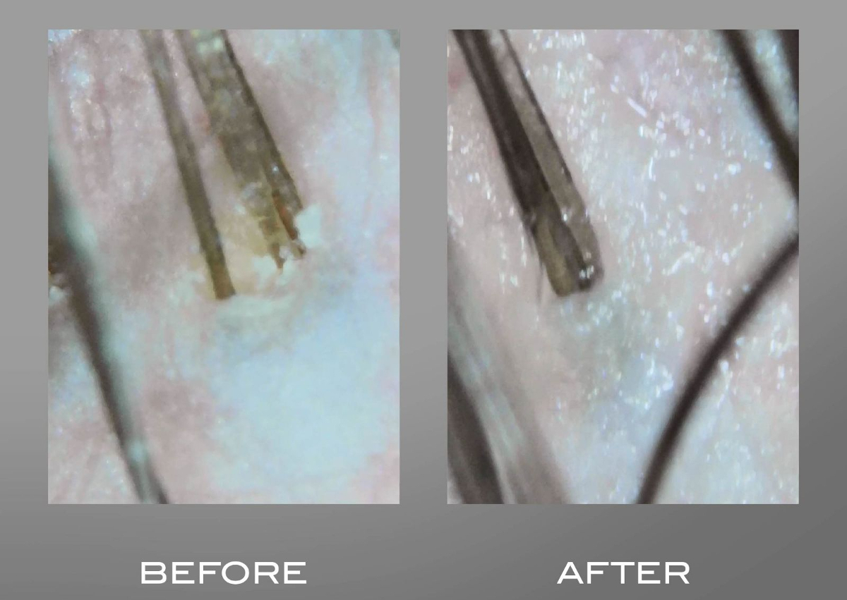 Scalp Facial W/Scope