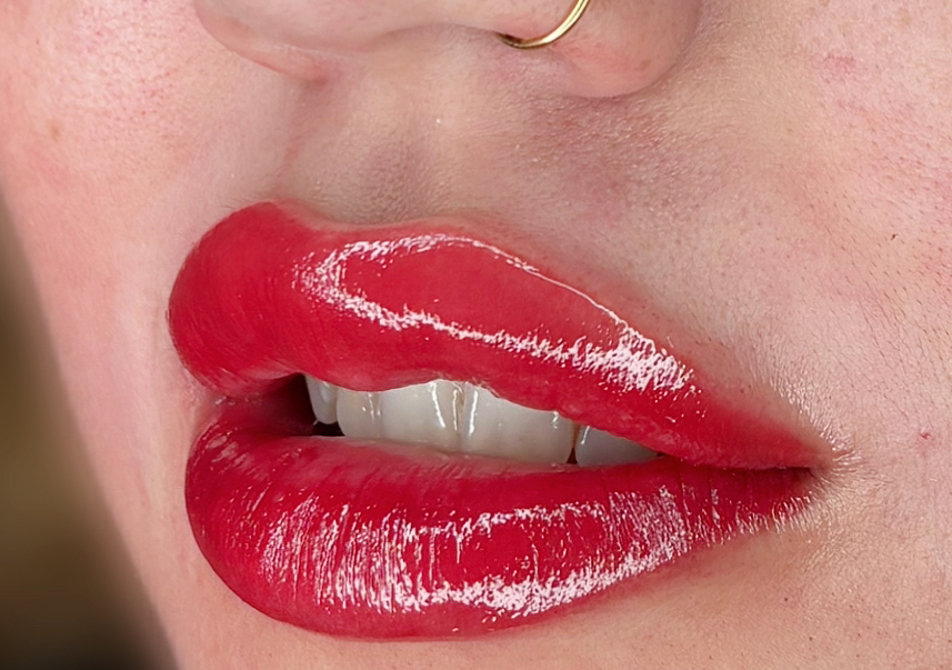 Upper lip hair removal|Depilación de bozo