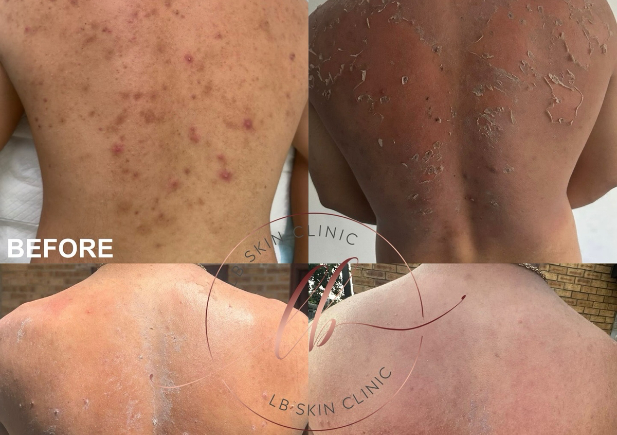 Back / Chest / Buttocks Skin Reset