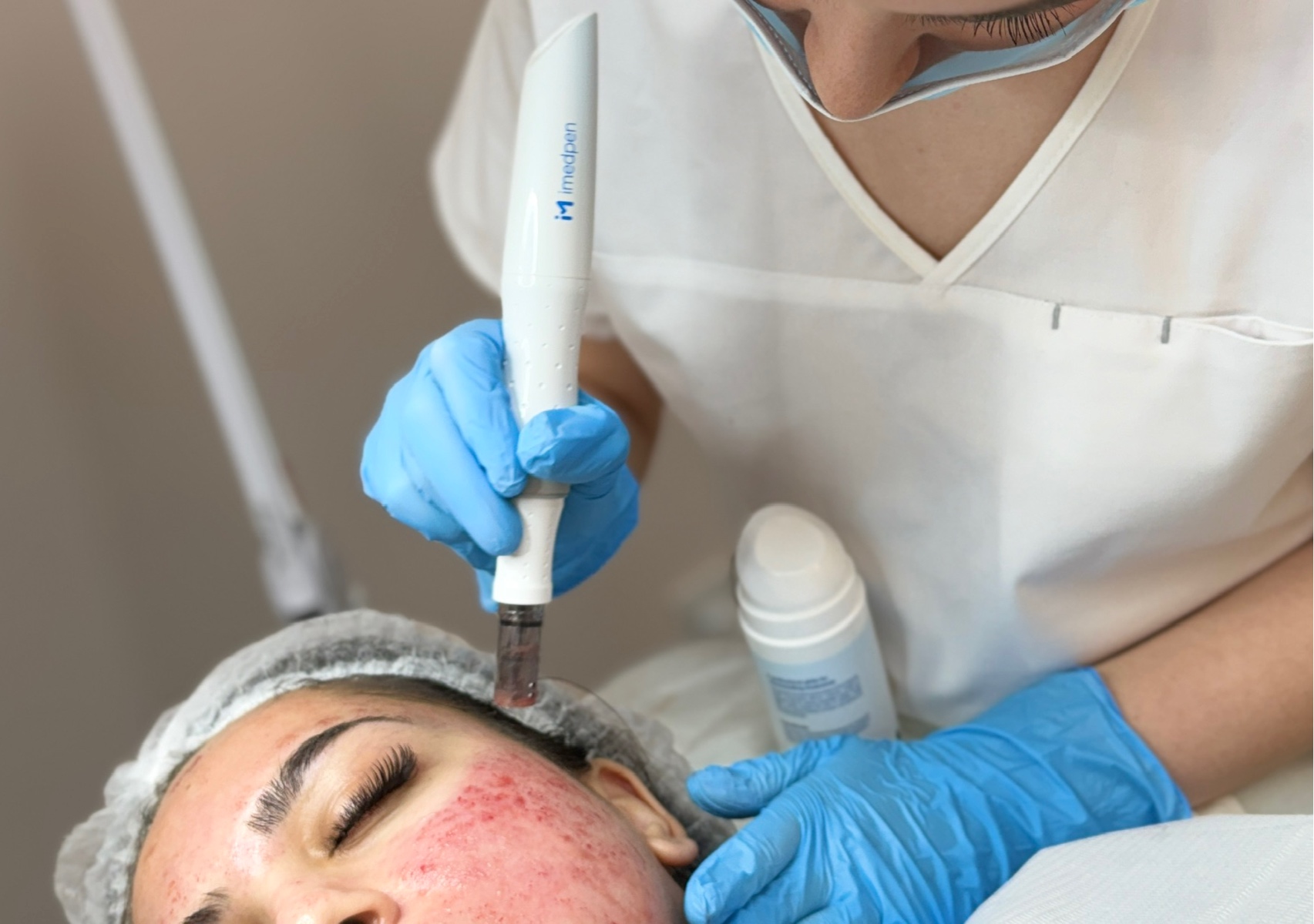 Medical Microneedling-Full Face