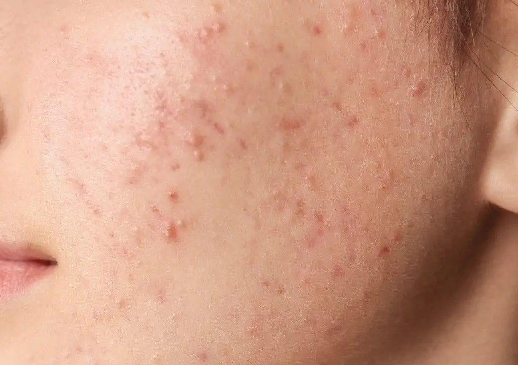 Deep Cleansing + BESPOKE Chemical Peel