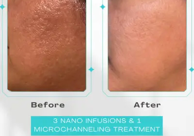 Microchanneling/Microneedling Facial 