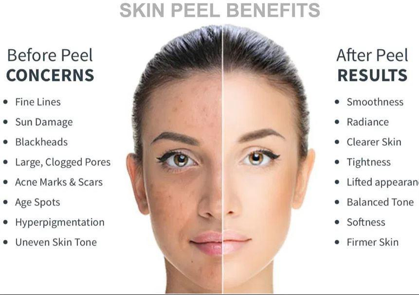 Chemical Peels