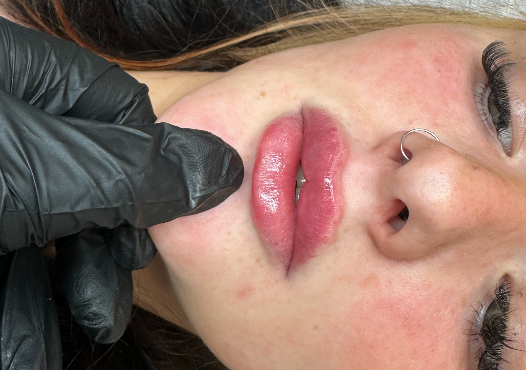 Lip Filler  - up to 1ml BF SALE