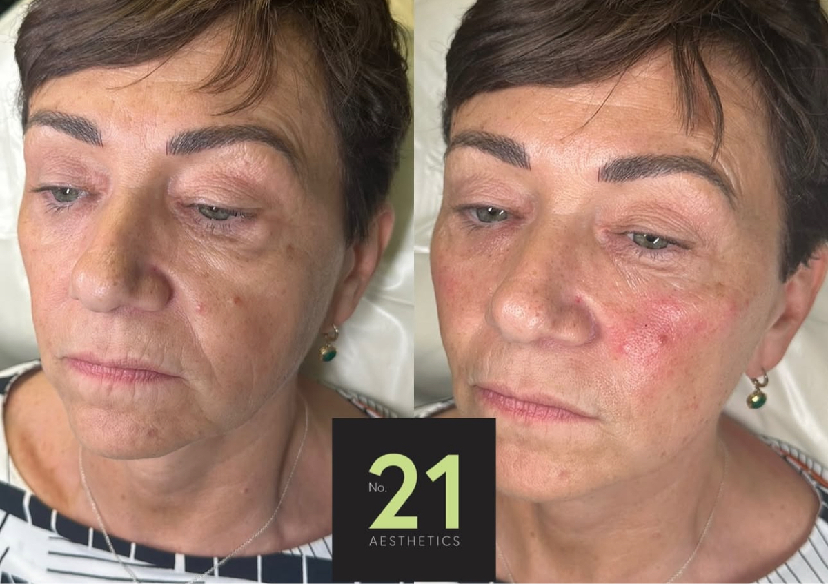 Cheek Filler- using 2ml