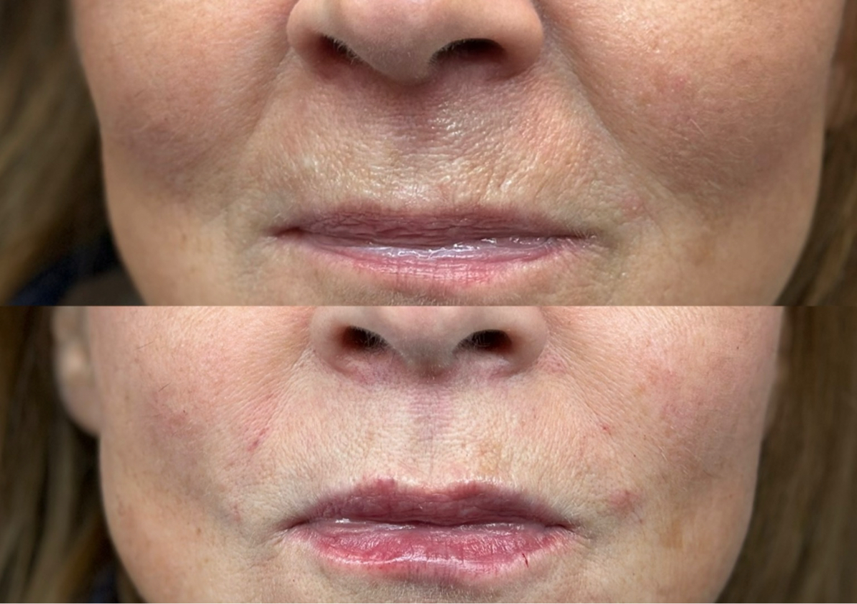 Nasolabial Fold Filler 