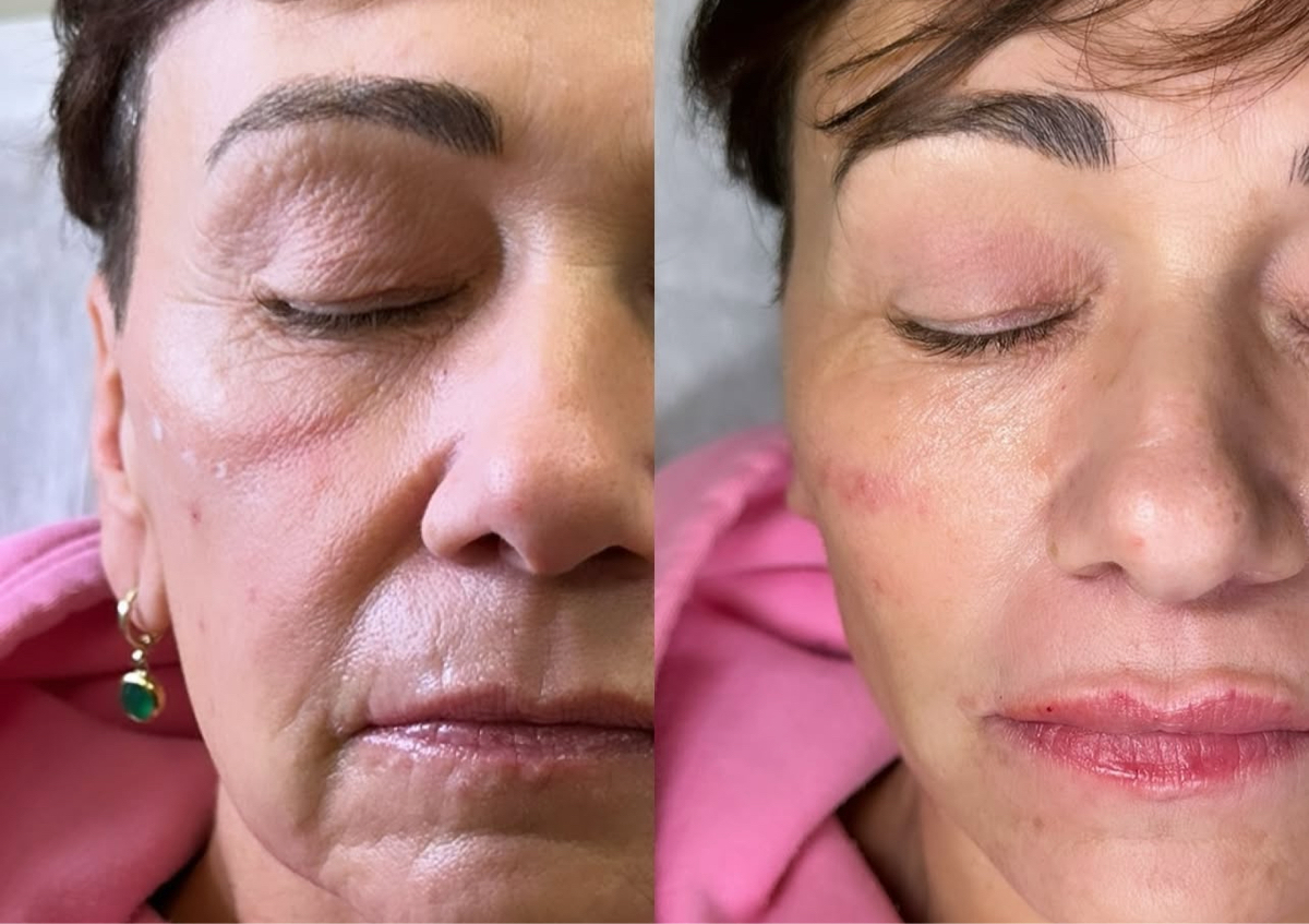 5ml Facial filler  - BF SALE - £100 off