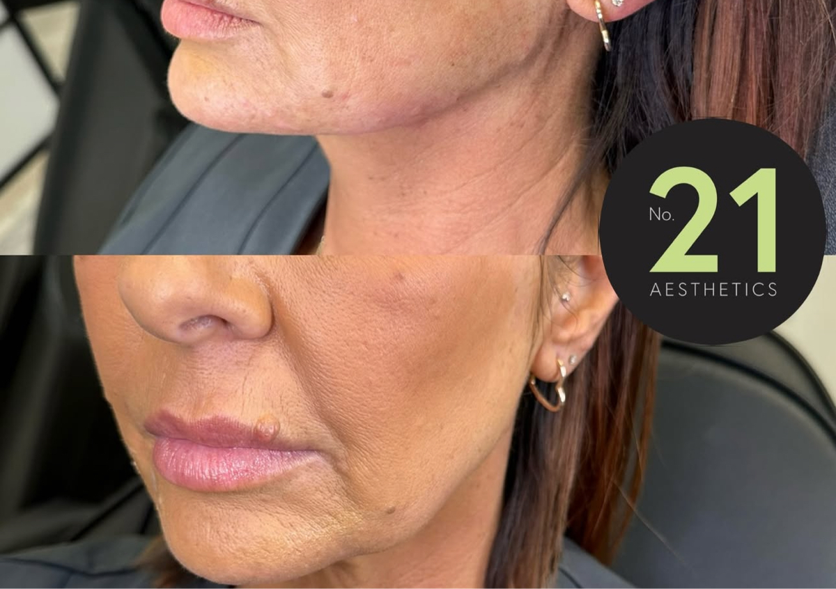 Jaw Filler (starting at 3ml - price varies ) 