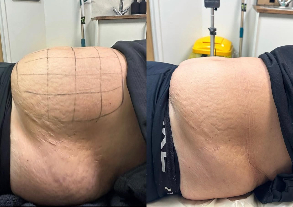 Lemon bottle - Large area