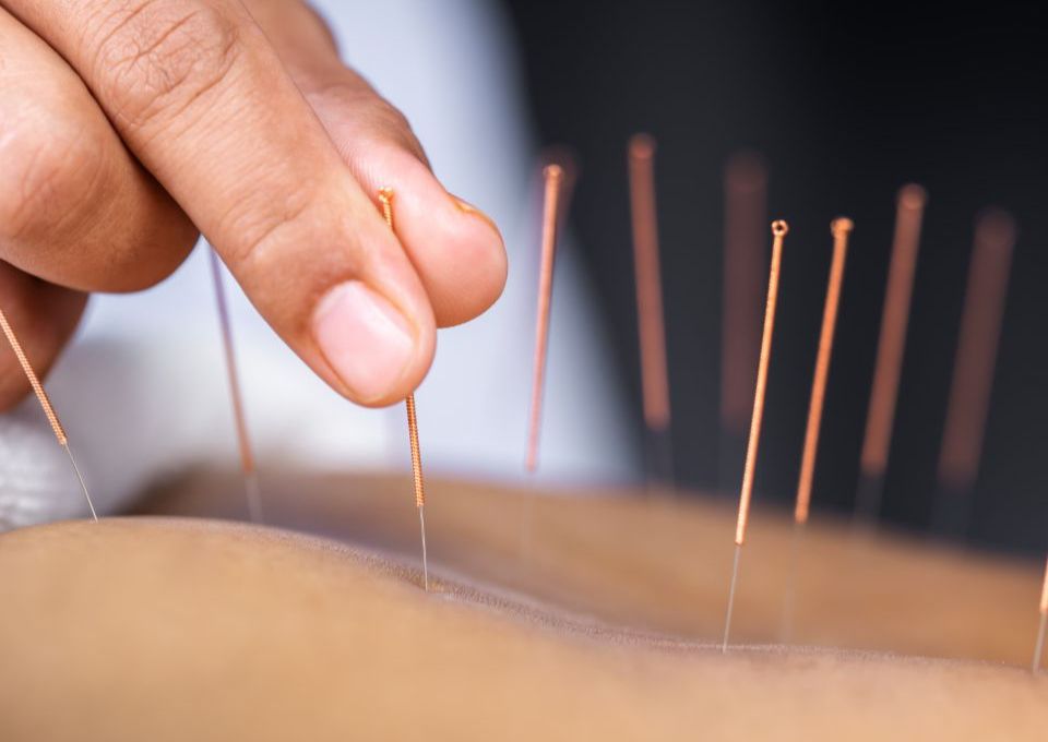 Returning Patient Acupuncture