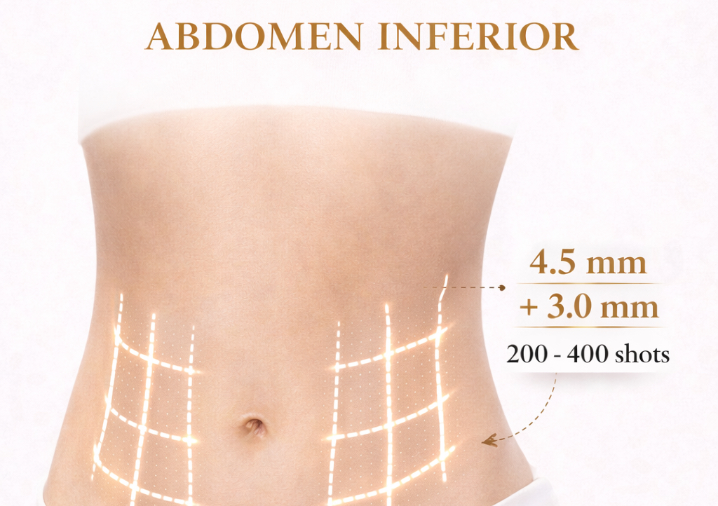 Hifu 7D abdomen inferior 