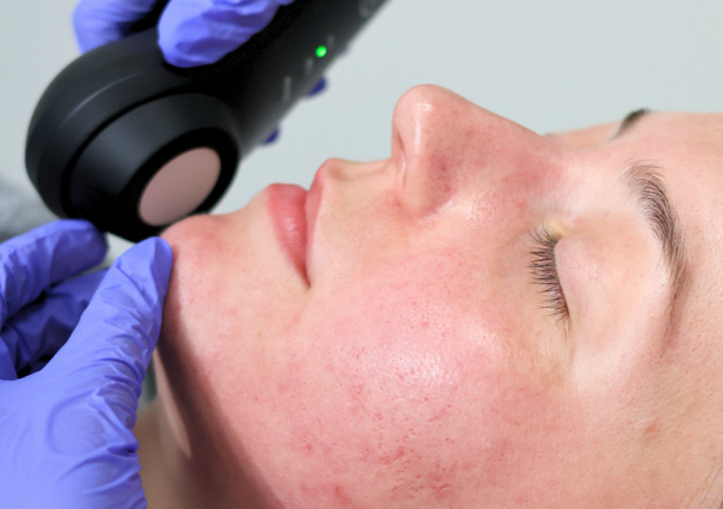 Cold plasma  Skin Treatment 