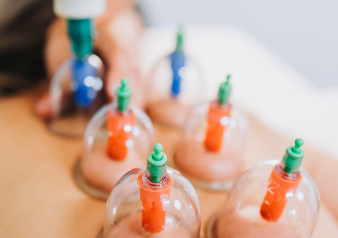 Masaje con ventosas (Cupping Therapy)
