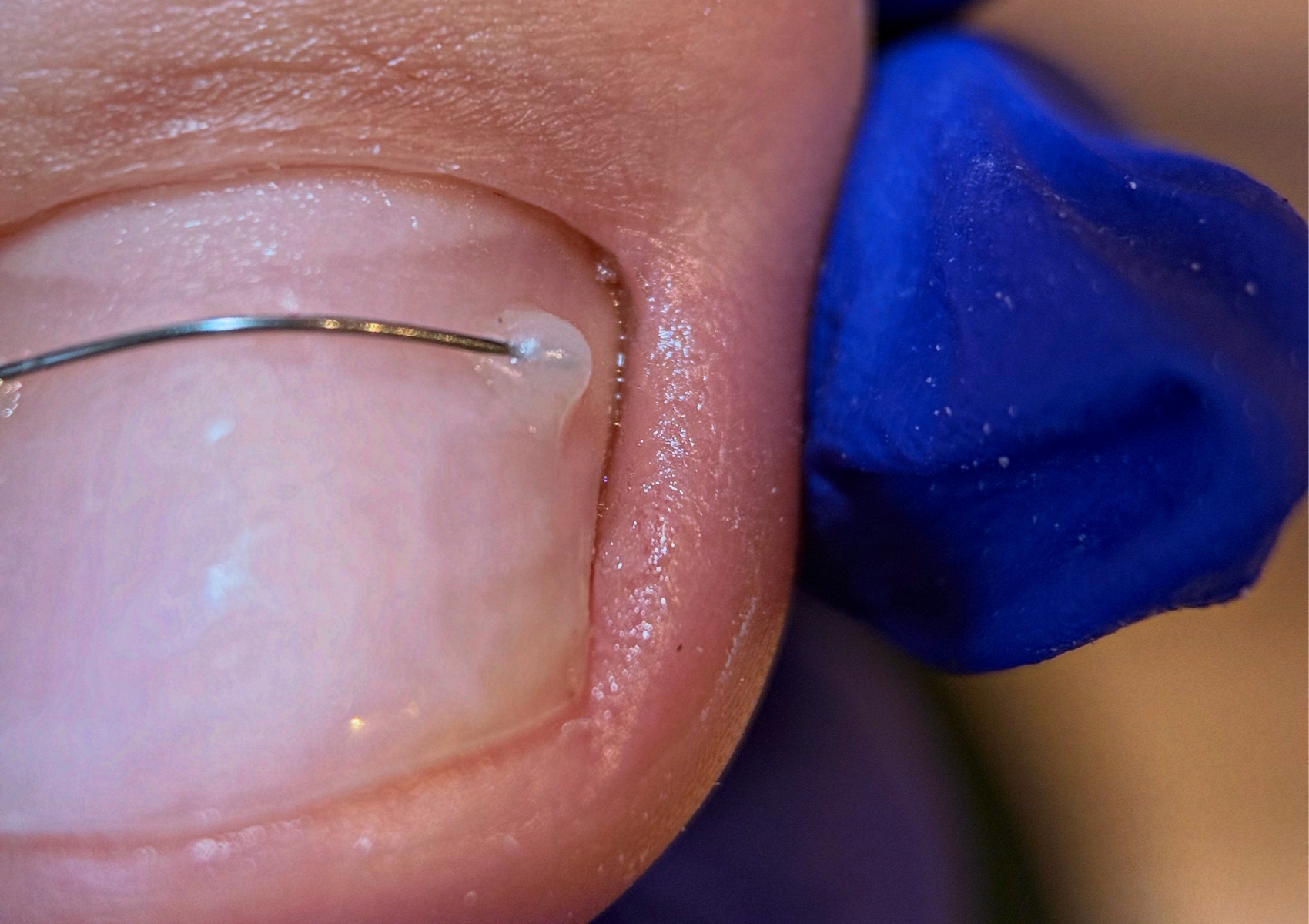 Corectie Fir de Titan 