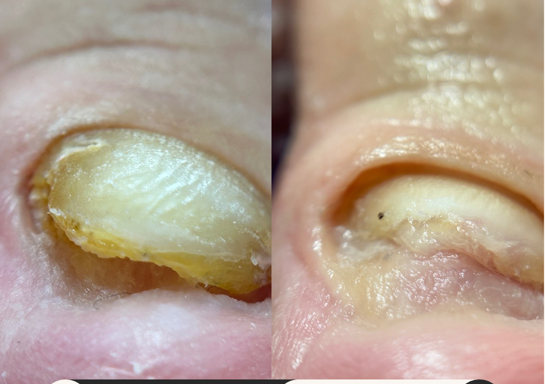 Intretinere Igienizare unghii problematice 