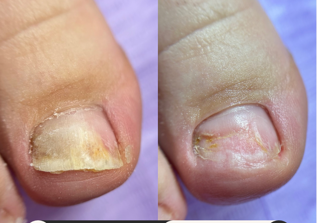 Igienizare pedichiura problematica 