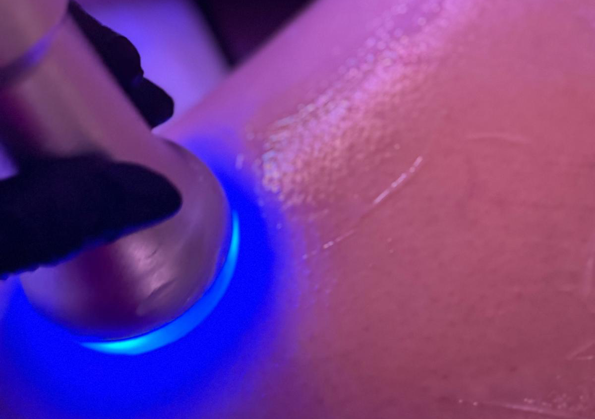 Cryo-Shape Corporal 5 sesiones