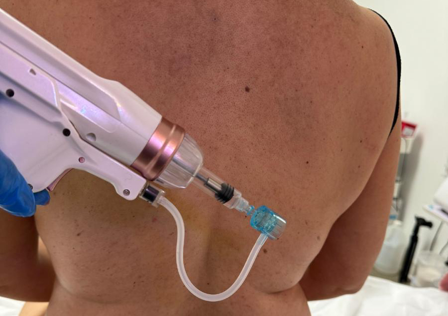 Mesoterapia 6 sesiones 1 área 