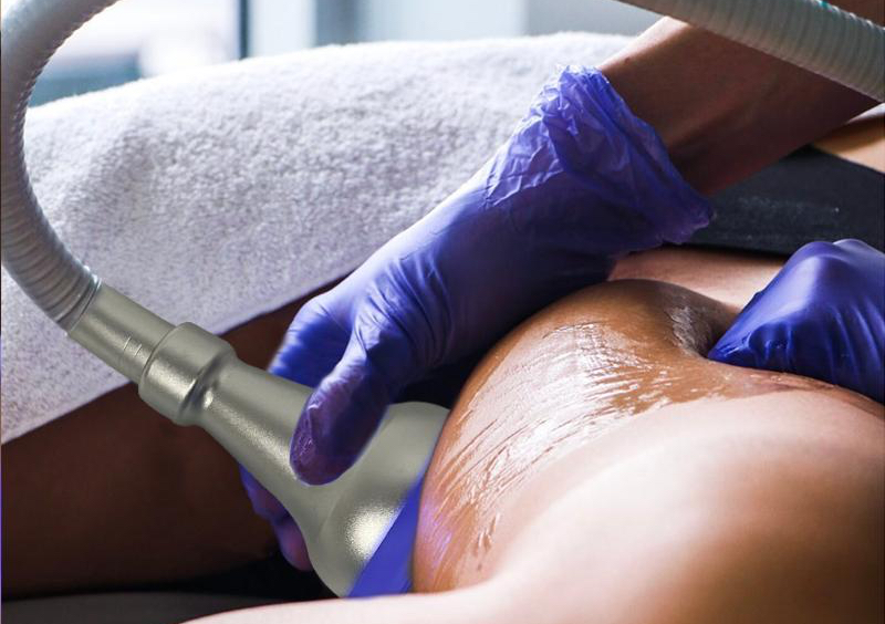 Cryo-Shape Corporal 8 sesiones