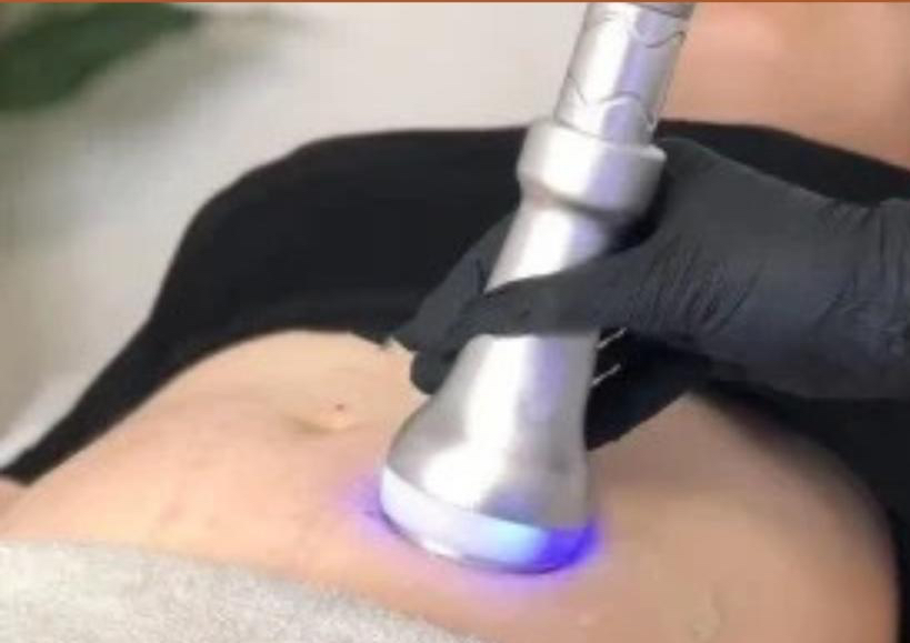 Cryo-Shape Corporal 6 sesiones