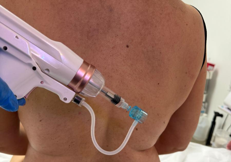 Mesoterapia 4 sesiones 1 área 