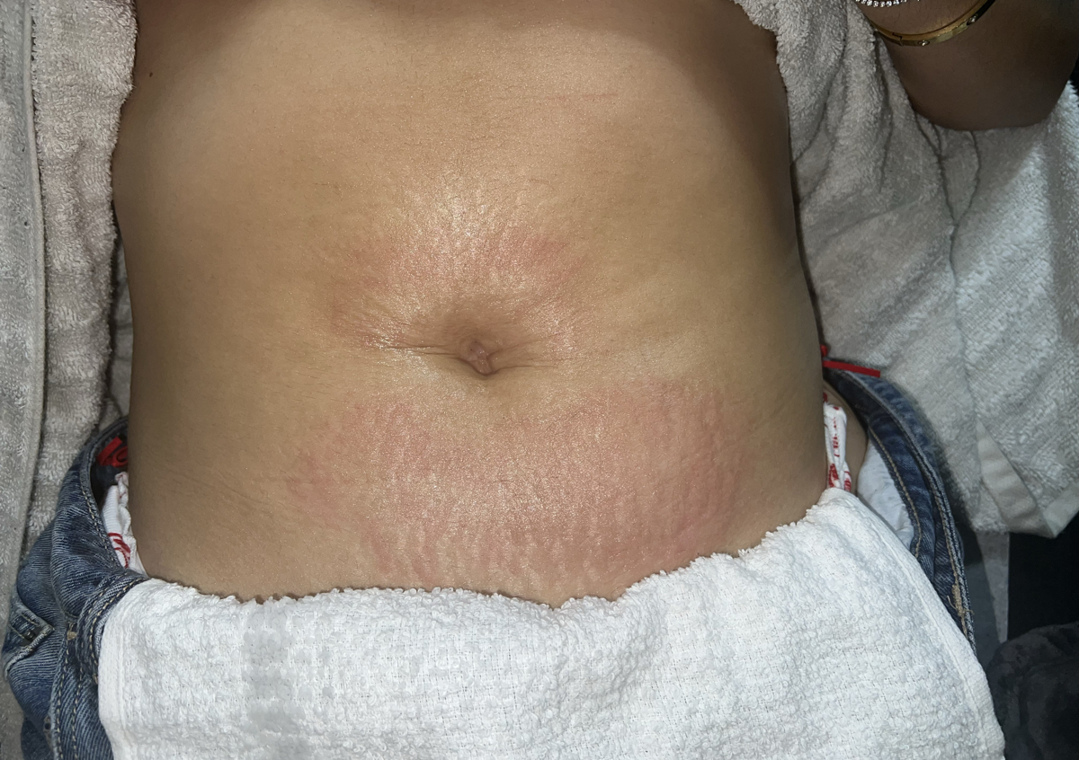 Tratamiento estrias 2 areas 