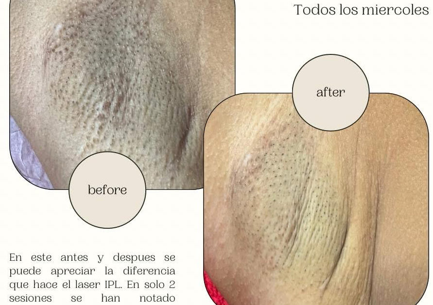Laser axilas (viernes y sábado) 
