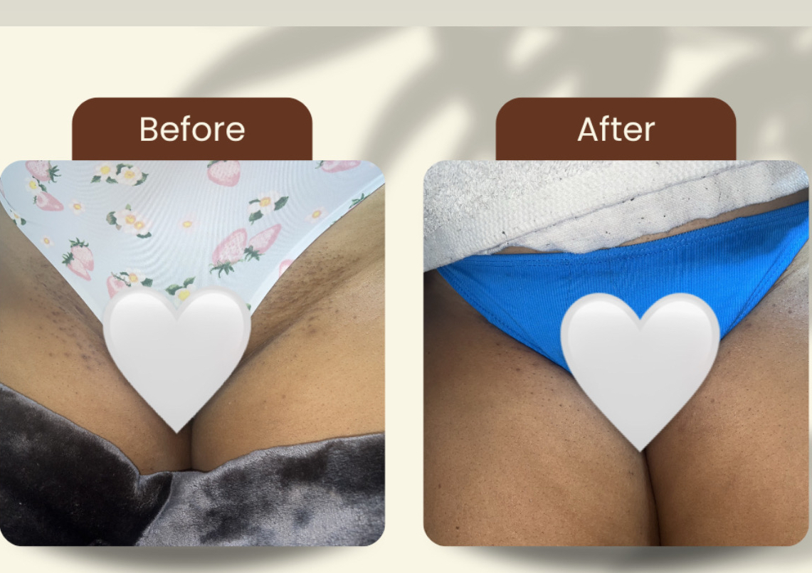 Laser bikini line 