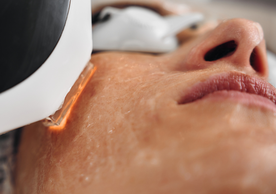 Facial Anti Acne 