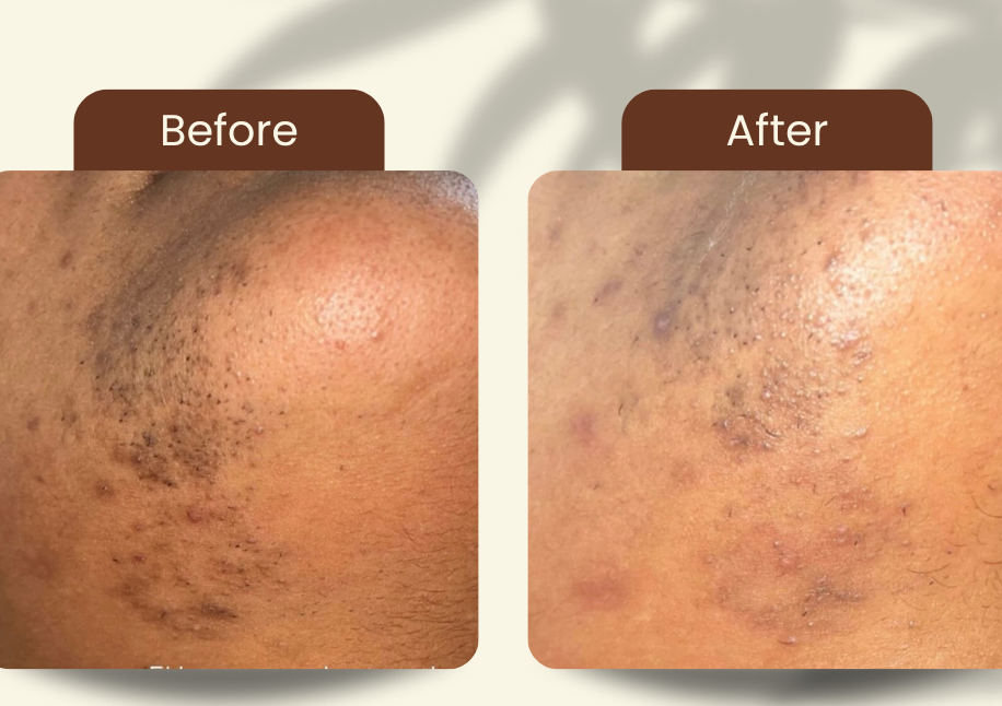Laser menton 