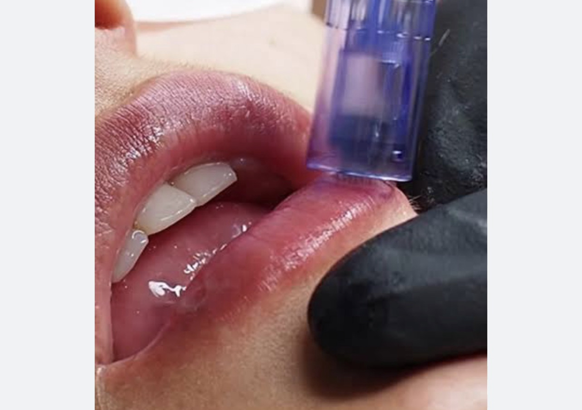 Hidratacion de labio 