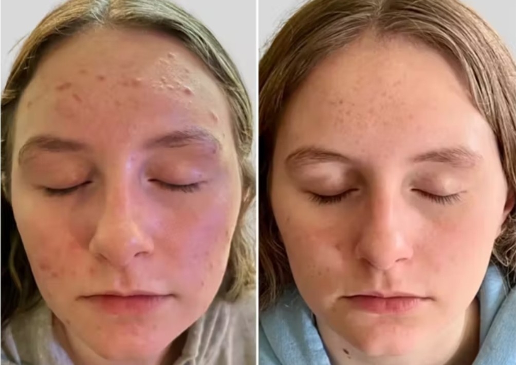 LED Light Therapy For Skin 