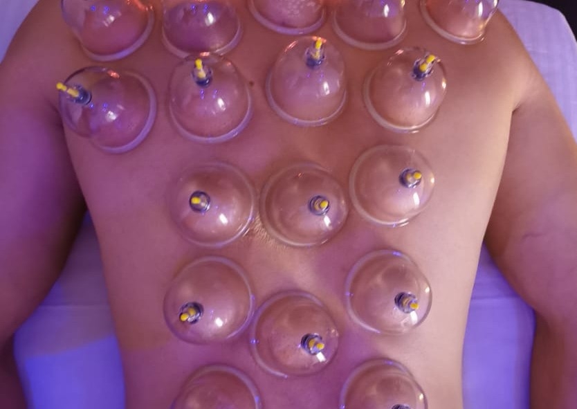 Chinese Cupping 