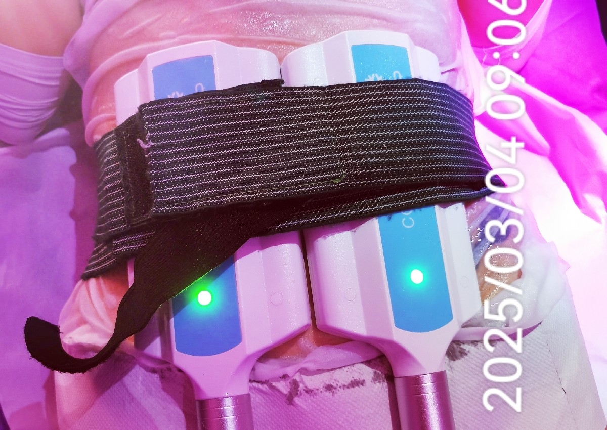 Cryolipolysis 2 PADS 