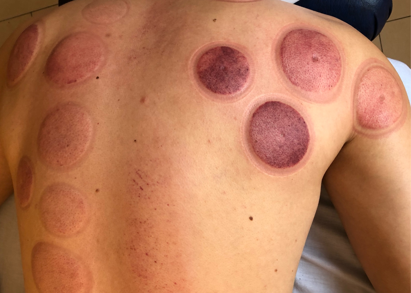 Cupping Therapy