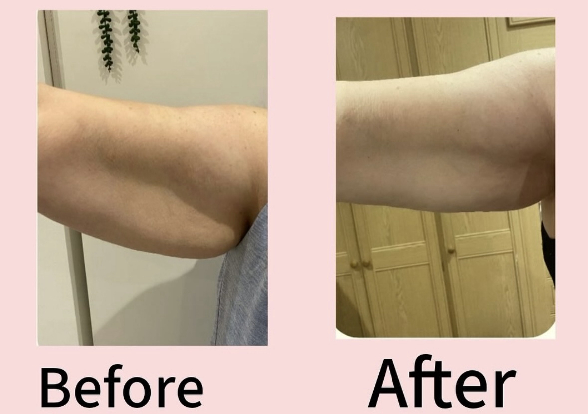 Hifu arms 