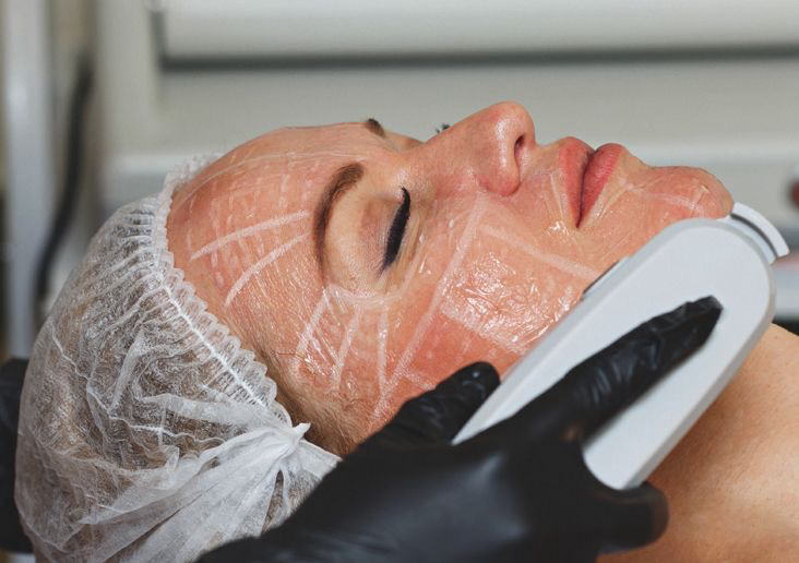 HIFU en rostro, cuello y hombros